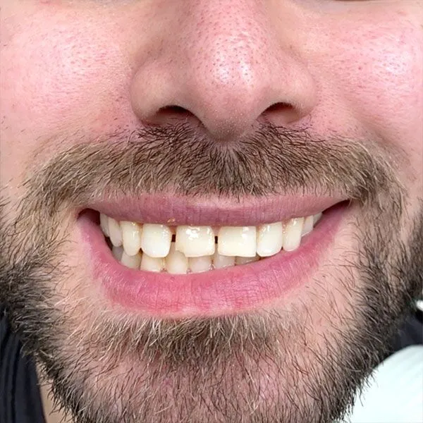 Farmington Dental Studio before and after result