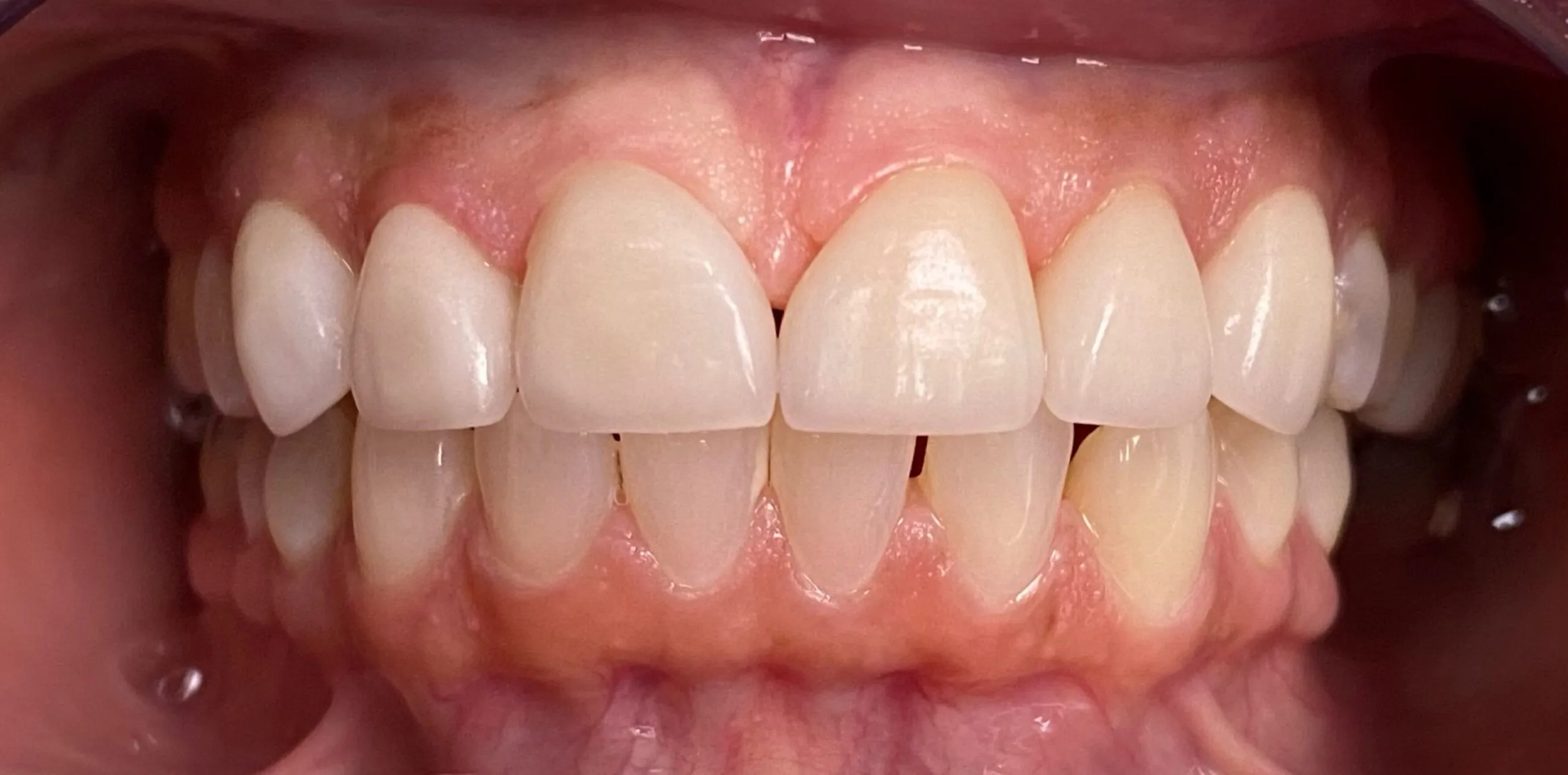 Farmington Dental Studio before and after result