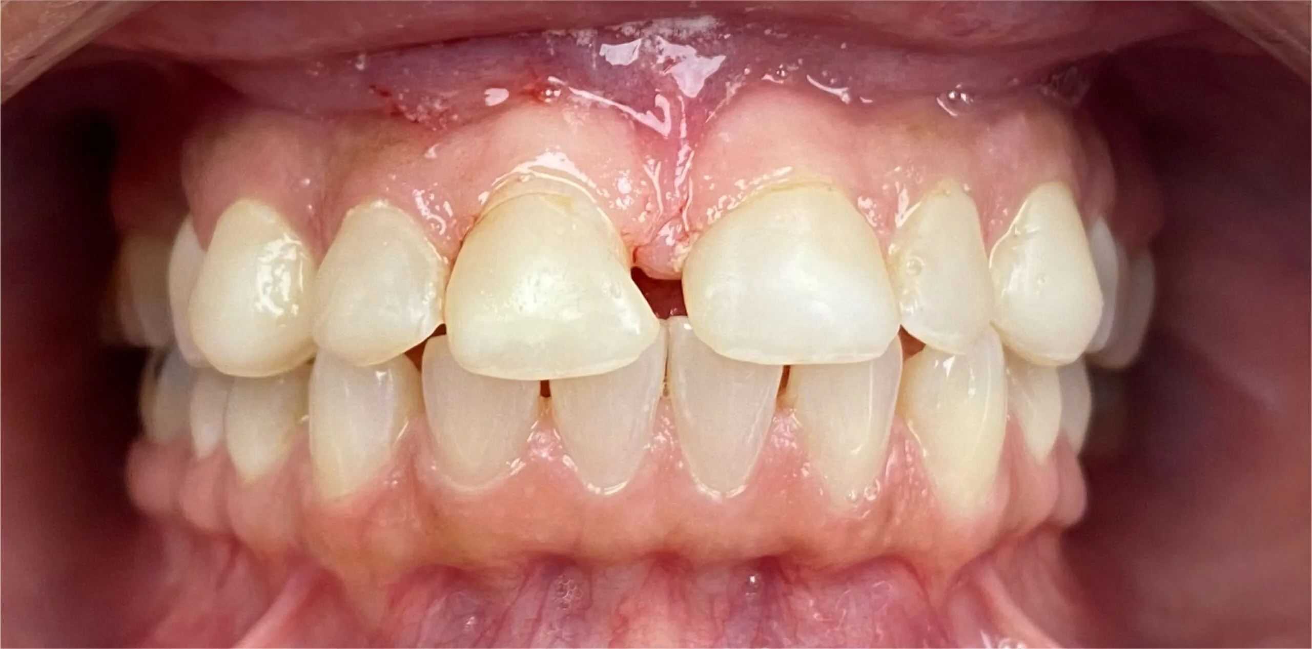 Farmington Dental Studio before and after result