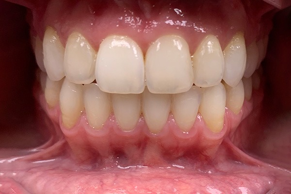 After dental treatment photo
