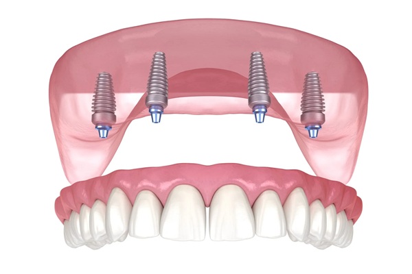 All-on-4 Implants