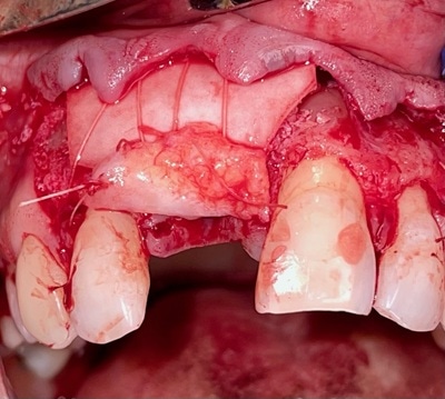 Failed Implant Case 10