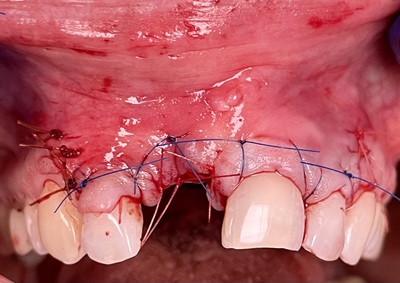 Failed Implant Case 11