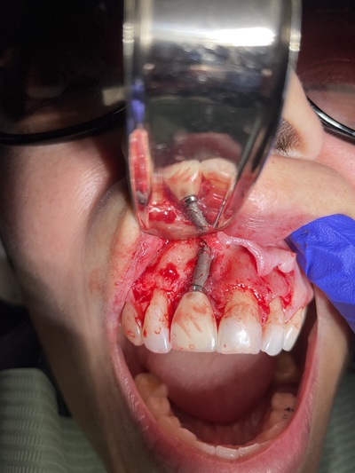 Failed Implant Case 3