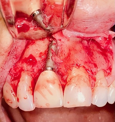 Failed Implant Case 4