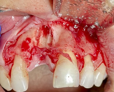 Failed Implant Case 5