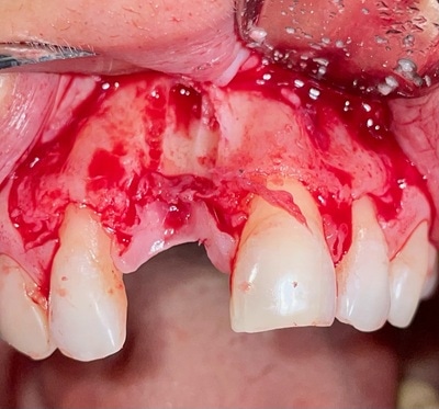 Failed Implant Case 6