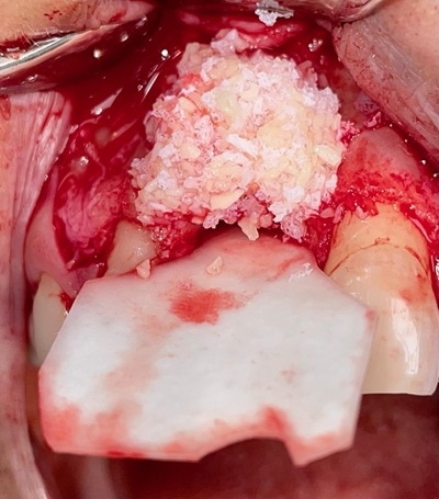 Failed Implant Case 7