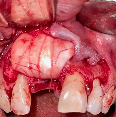 Failed Implant Case 8