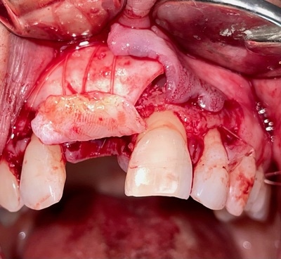 Failed Implant Case 9